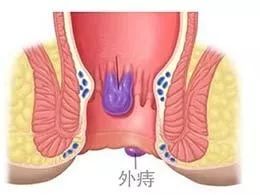 北京丰益肛肠医院：“医生，我肛部里长出了小尾巴，是啥东西？”