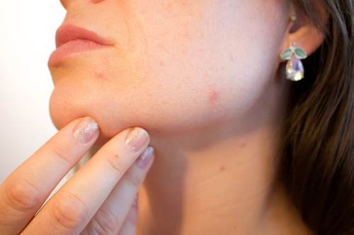 鼻子上出现痤疮的原因有哪些?如何有效的防止痤疮出现?