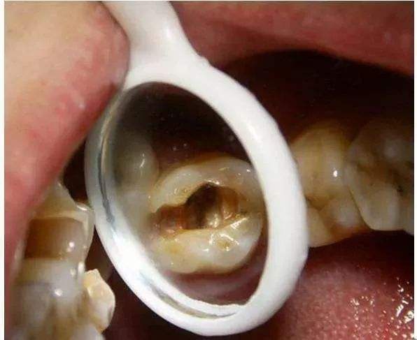 儿童蛀牙的危害大，千万不容忽视！
