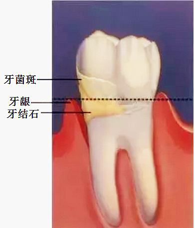 关于牙结石，你想知道的都在这里！