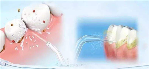 洗牙，扫除牙齿危害、恢复牙周组织健康！