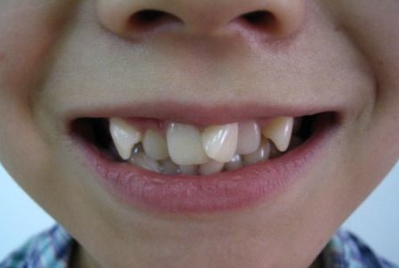 医院库 武汉麦芽口腔医院 疾病知识    ⑦牙齿畸形:是指儿童在生长
