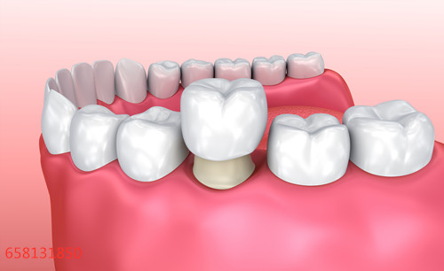 牙齿修复是做烤瓷桥还是做活动假牙？
