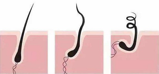 遗传性秃顶，在什么前提下可以植发？