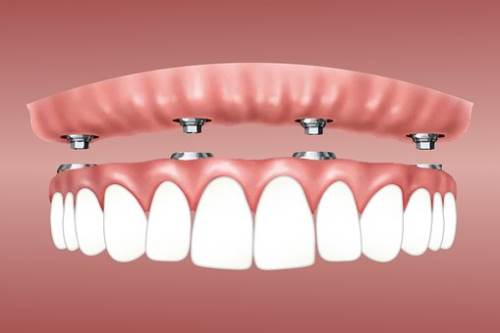 做完冷光美白牙齿手术后有哪些注意事项!哪些方法美白牙齿更加有效?