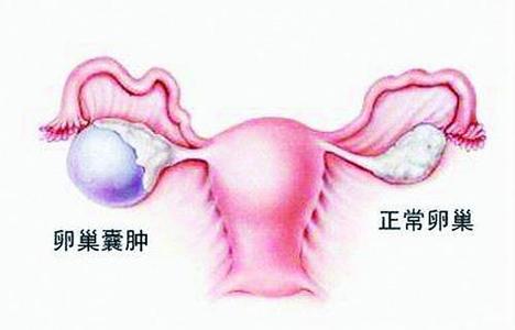 2,月经紊乱:卵巢囊肿会