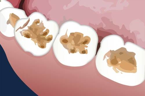 出现龋齿的原因及其相关疗法有哪些？学学知识保护孩子牙齿