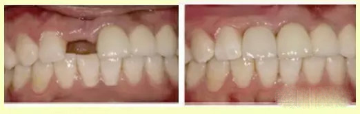 口腔医生温馨提示：牙齿缺失危害大，修复要趁早！