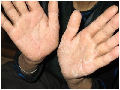 手部牛皮癣治疗要注意什么,需要避免接触过敏源吗