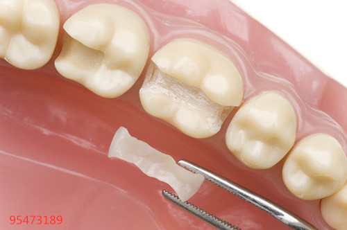 补牙之后牙齿会痛吗？会和补牙材料有关吗？
