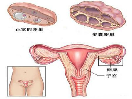 得了多囊卵巢，该怎么保养改善？