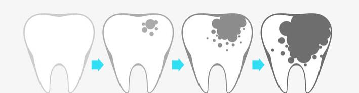 「口腔疾病」牙髓炎的症状都有哪些？