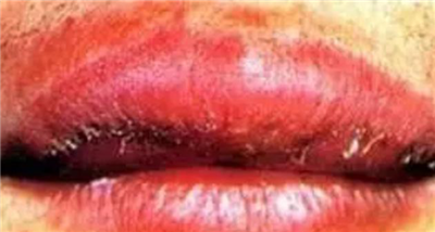 您属于哪种类型的唇炎？看看这几条中了吗