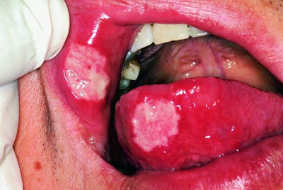 口腔溃疡频繁发作是什么原因？这些你都清楚吗