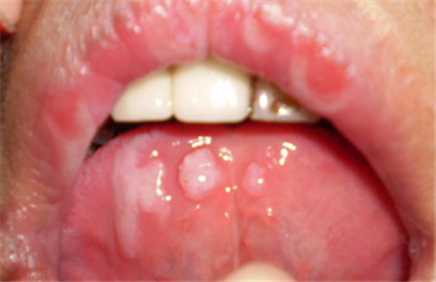 口腔溃疡老是治不彻底，有什么危害？