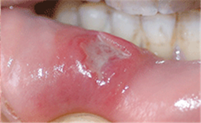 口腔溃疡发病初期时的症状表现，帮助患者更及时发现病情，及早诊治