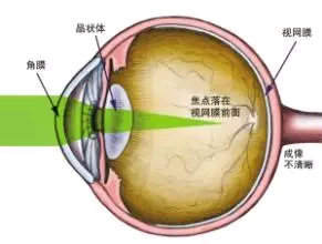 【北京熙仁眼科医院】近视、远视、散光，都是因为这个原因！