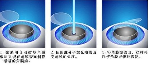 如果我们的眼睛近视了，时间应该戴眼镜还是做手术比较好?