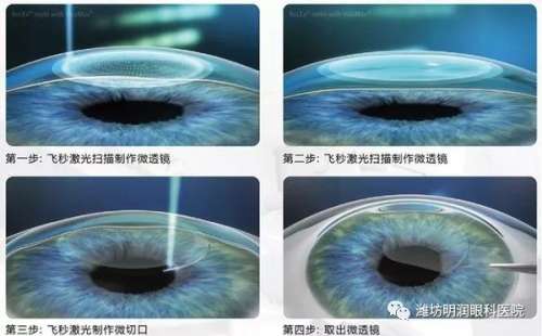 当“近视”遇到“全飞秒3.0”，新技术让你知道治疗近视就是如此简单