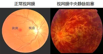 【北京熙仁眼科医院】严重的眼底病能治好吗？