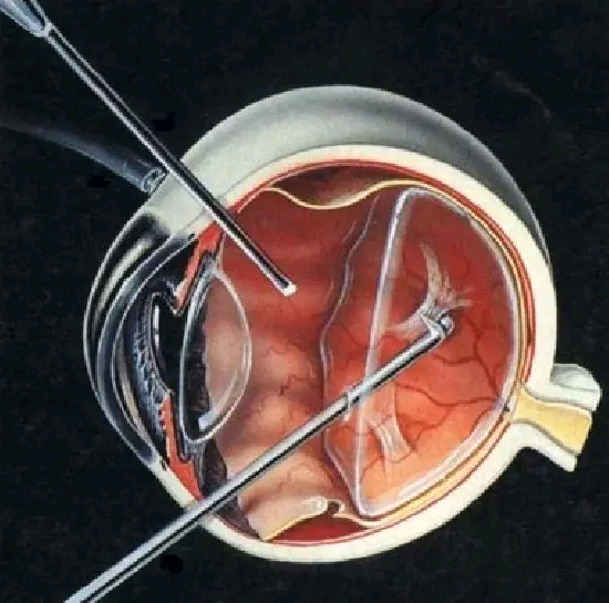 视网膜脱离不容小觑 严重可致失明