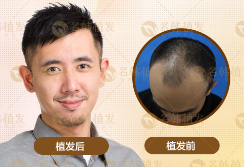 脱发是什么？植发手术是怎样改善脱发姣况的？