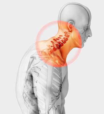 颈肩痛就是颈椎病？颈椎病的五个常见误区你有吗?