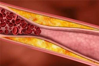 动脉硬化的产生和这7个常被忽略的原因分不开