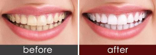 牙齿美白是什么？有哪几种方式呢？