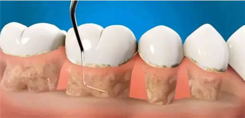 洗牙和牙周刮治有什么区别？不都是清洁牙齿吗？