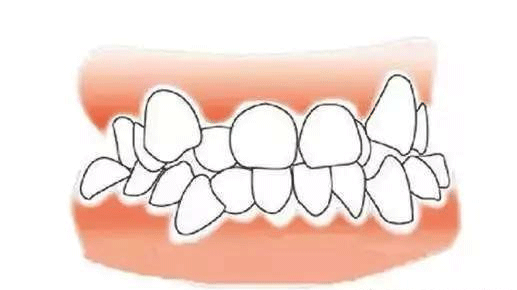 12岁前要处理的10种儿童牙颌畸形