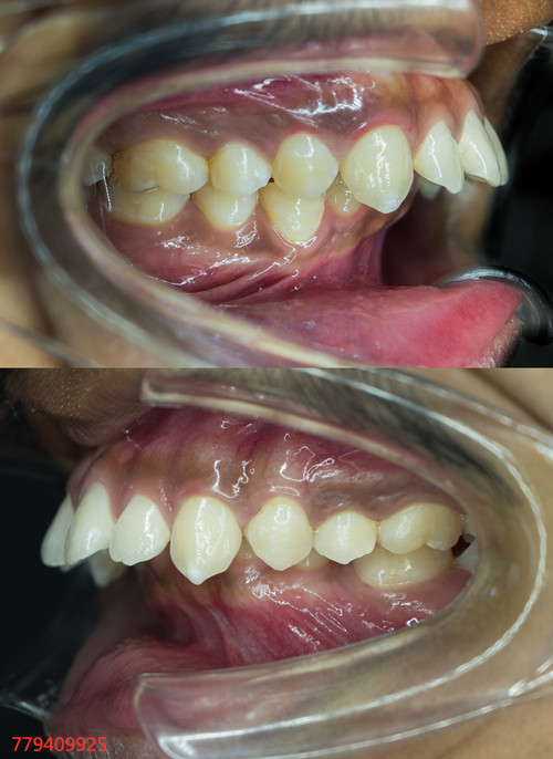 骨性龅牙和牙性龅牙，不都是龅牙，有什么区别吗？