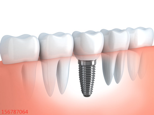 种植牙手术有三个阶段，你知道几个？