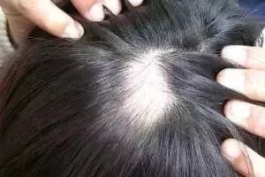 名韩植发医生介绍：脱发的几种类型！