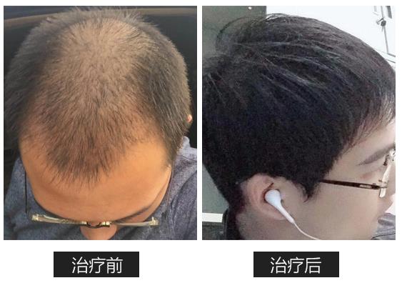 名韩植发医生介绍：脱发的几种类型！