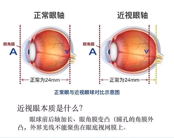 高度近视眼可以做激光手术吗？你要符合以下基本条件吗？
