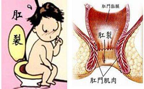 得了肛裂有什么危害？你不得不重视