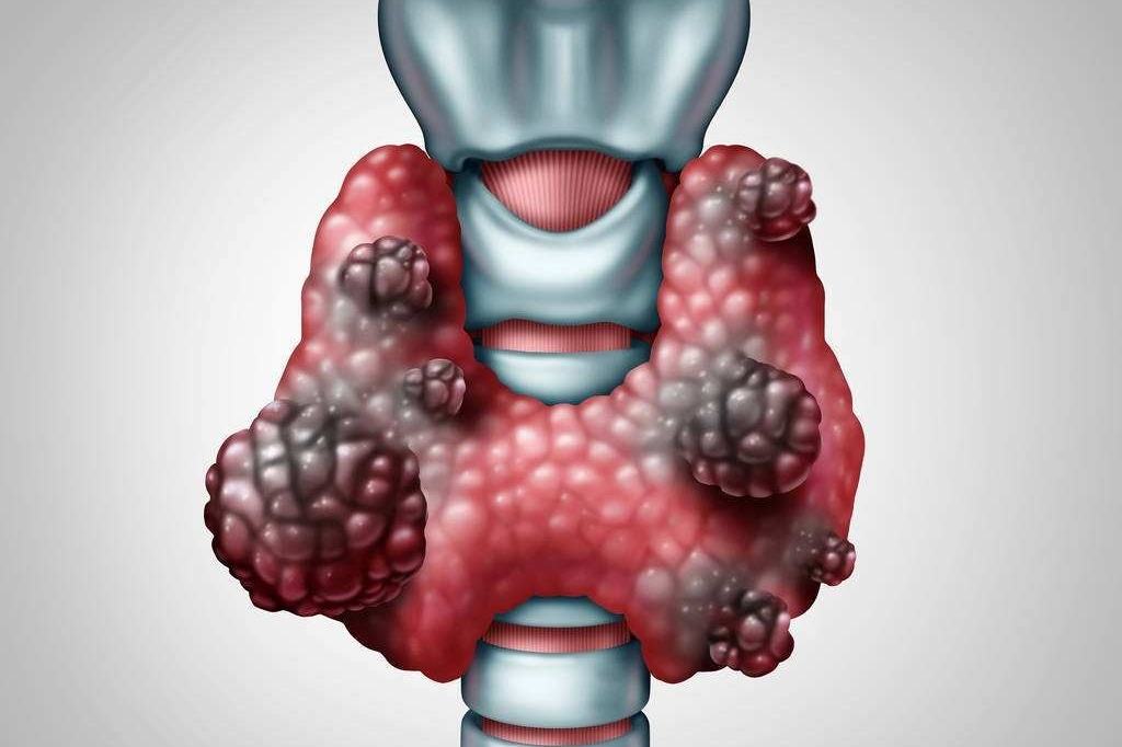 甲状腺结节发生“质”的改变，出现这4种症状千万要当心！