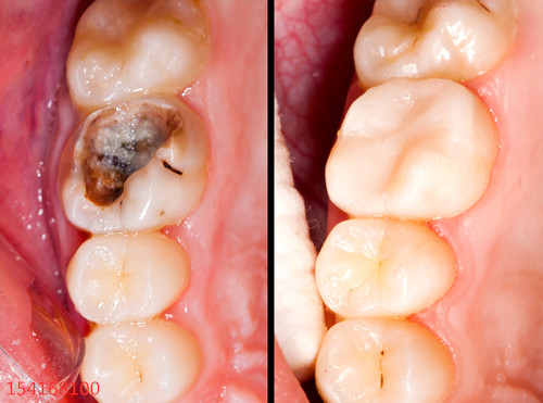 龋齿龋到只剩下牙根了，能用来镶牙吗？