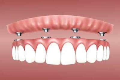 牙齿矫正的步骤是什么，这些你有了解吗?