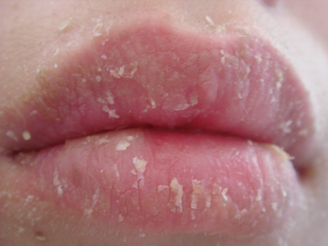 唇炎的病发原因都有哪些?这些原因日常生活当中一定要