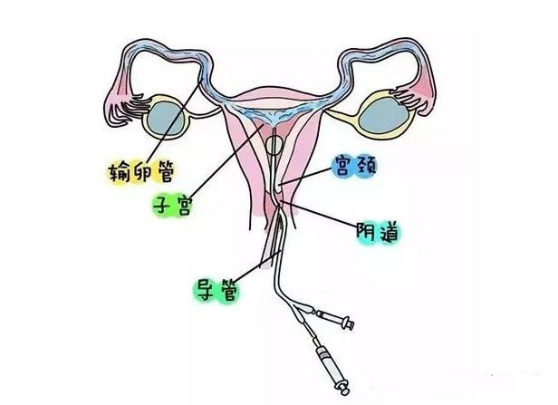 输卵管检查，是否每位不孕患者都需要做吗？