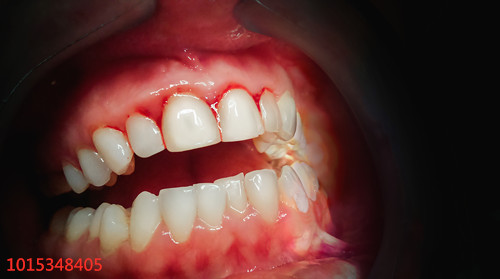 不小心患上牙周炎，该怎么处理？