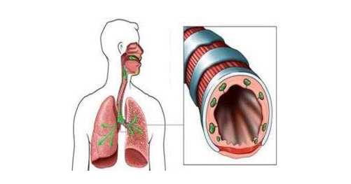 支气管扩张的诱因有哪些？支气管扩张应该怎样治疗？