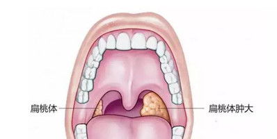 扁桃体肥大的症状，会有什么样的影响？