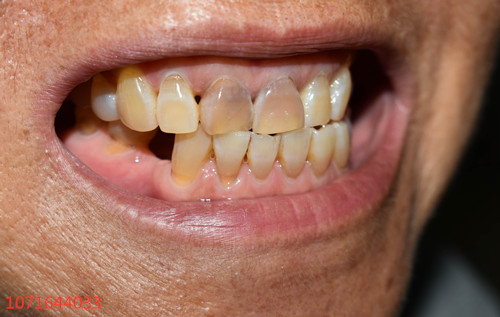 你以为是你的牙齿越长越长，其实是牙龈萎缩在作怪