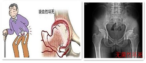 曹志光讲介绍患有股骨头坏死该如何治疗呢