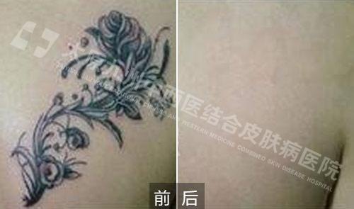 洗纹身选择太原九州医院痕，一定要了解清楚