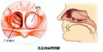 鼻息肉的症状是什么，如何判断自己是否得了鼻息肉