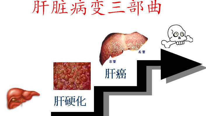 肝癌的病因有哪些？日常生活当中一定要注意这些原因